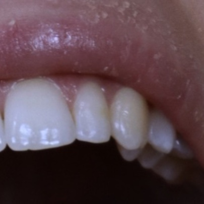 A close up photograph of a person's mouth, showing the top row of their teeth and their upper lip.