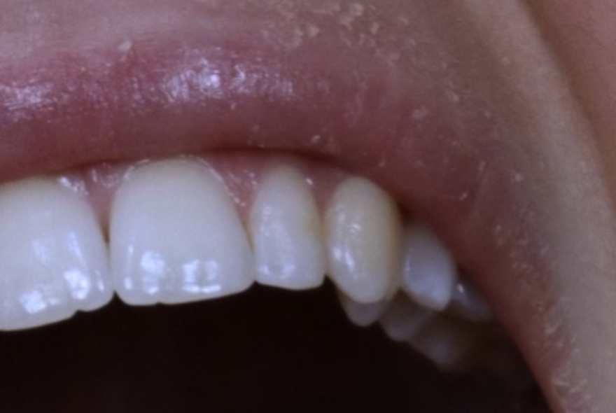 A close up photograph of a person's mouth, showing the top row of their teeth and their upper lip.