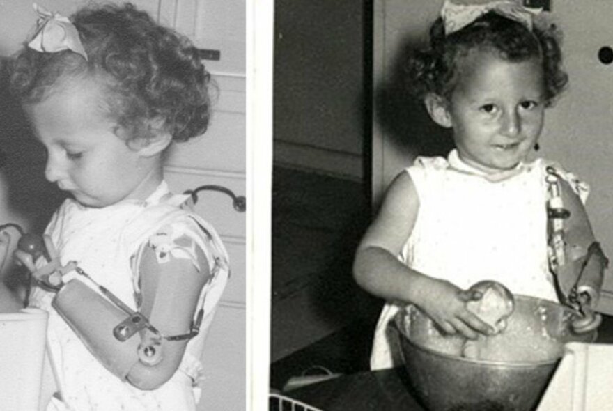 A series of two vintage photos circa 1960, side by side, of a young child with short curly hair and a prosthetic arm. 